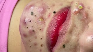 Big Cystic Acne Blackheads Extraction Blackheads \u0026 Milia, Whiteheads Removal Pimple Popping # 1668