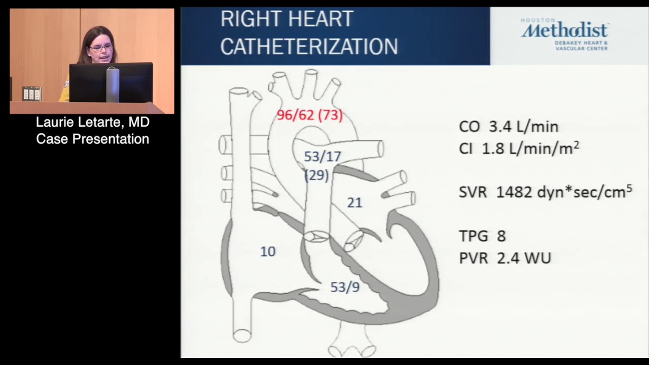 Debate: Options For End Stage Heart Failure: Heart Transplant Or LVAD ...