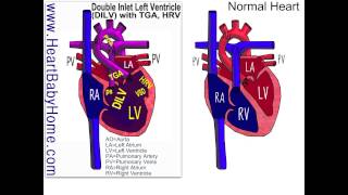 32 Double Inlet Left Ventricle with HRV and pulmonary stenosis