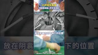 25秒轻松看懂！人工阴茎海绵体手术全流程 医学科普 男性健康 手术 硬核健康科普行动