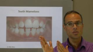 Teeth Mamelons By Dr Mike Mew