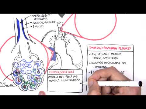 What is lobar pneumonia?