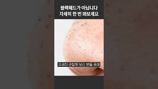 블랙헤드가 아닙니다! 자세히 한 번 봐보세요 #소극성속모증 #가시털정체증 #블랙헤드