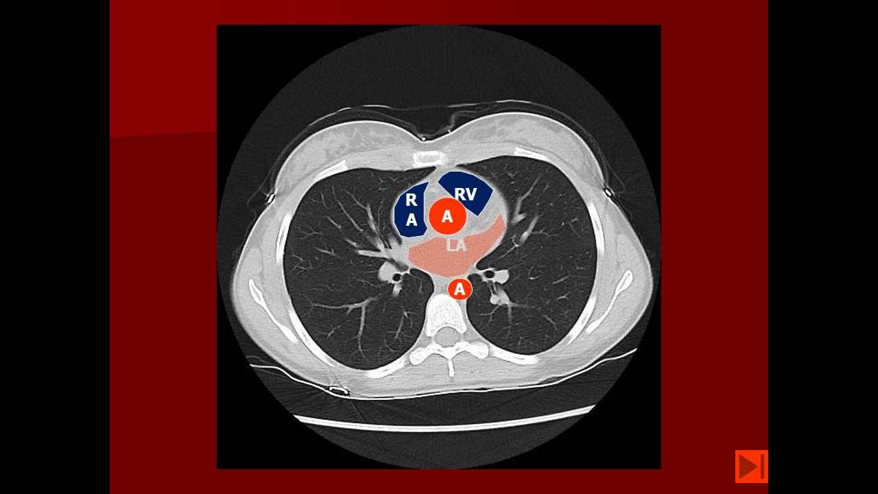 Labeled Chest CT Scan Anatomy