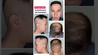 Hasil transplant rambut di Turki setelah 9 bulan! #transplantrambut #tanamrambut #tanamrambutturki