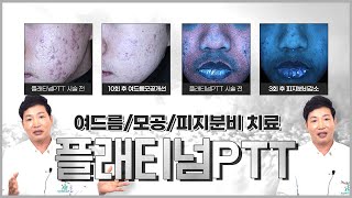 여드름치료 모공 피지억제 이걸로 종결? 백금!! 플래티넘PTT