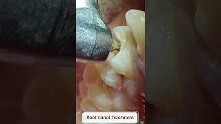 Painless Root Canal Treatment