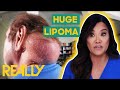 Dr. Lee Removes A Massive Lipoma From A Man's Neck | Dr. Pimple Popper