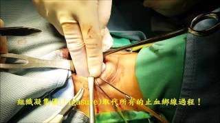 甲狀腺手術 能量刀 Ligasure Thyroidectomy Video Dr Ken Liao LIU