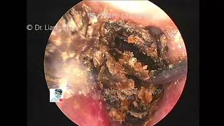 Endoscopic ear treatments by Dr Zhao EP.30- 04/06/2020