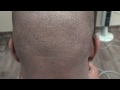 fue donor scar 12 months result hairline transplant restoration result dr. diep www.mhtaclinic.com