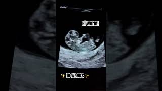 10 weeks pregnant ultrasound scan! #shorts