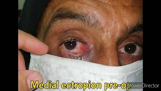 Ectropion | Medial Ectropion | Conjunctivoplasty | Ectropion Correction |