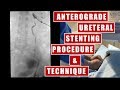 Trans-nephrostomy Ureteral Stent placement under fluoroscopy guidance: procedure and technique