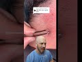 extreme ingrown hair drreacts ingrownhair supersatisfying