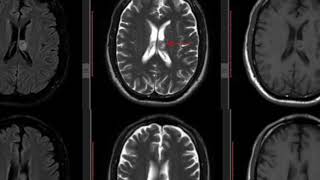 TMT: Neuro Short Cases Series by Dr Devarati Khurjekar (6)