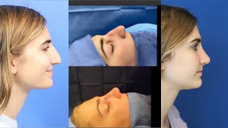 Magical Transformation - Teen Rhinoplasty | Plastic Surgery by Dr. Ali Sajjadian | Before \u0026 After