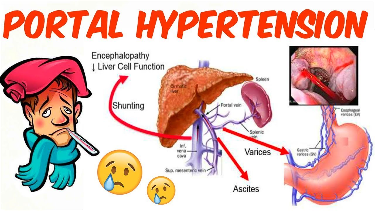 Portal Hypertension By Prof. Marwa Al Emam - YouTube