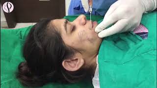 Live Facial Fat Grafting Surgery at Profile Studios