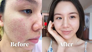 14-DAY SKINCARE ROUTINE that CLEARED my Acne-prone,  Sensitive skin [ENG CC]