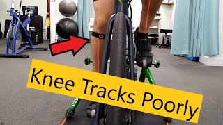 Knee pain from cycling due to poor tracking | The significance of a biomechanical assessment