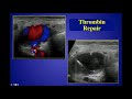 pseudoaneurysms diagnosis and treatment by john s pellerito md hd