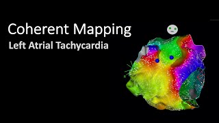 Coherent Mapping: Left Atrial Tachycardia after Previous AF Ablation