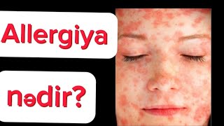 ALLERGIYA Nədir? Növləri və Simptomlar