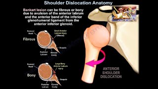Shoulder Dislocation Anatomy - Everything You Need To Know - Dr. Nabil Ebraheim