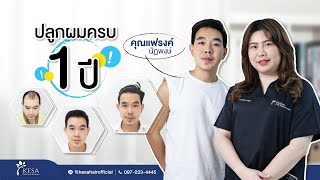 รีวิวผลลัพธ์หลังปลูกผมเทคนิค NNN ครบ 1 ปี ผมขึ้นดกดำเป็นธรรมชาติ