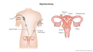 Myomectomy surgical procedure to remove uterine fibroids ; Abdominal, Laparoscopic, Hysteroscopic