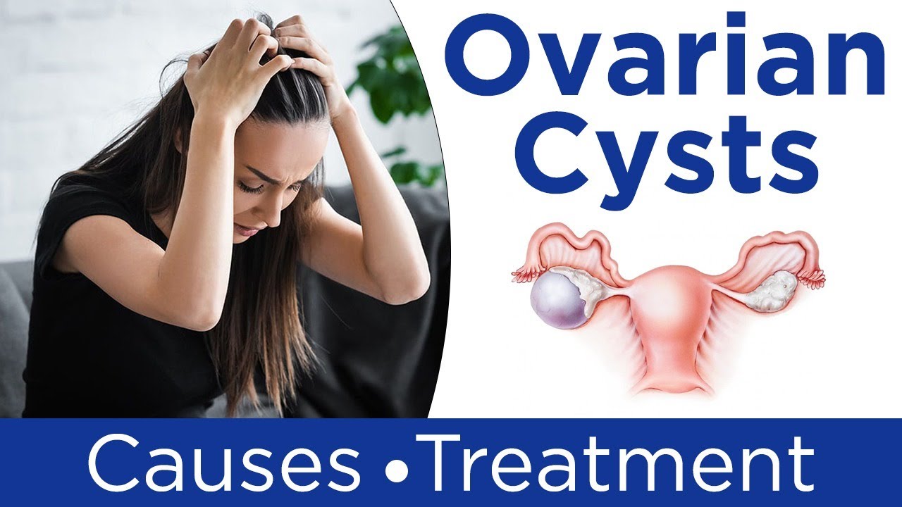 Ovarian Cyst Causes Symptoms And Treatment 50 Off Ovarian Cyst Causes Symptoms And Treatment 50 Off