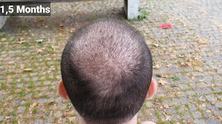 FUE Hair Transplant Timeline I Day 1 to Day 365 I Before & After