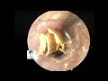 Postoperative cleaning of cholesteatoma