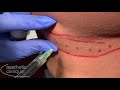 treating the banana roll with kybella dr. steven f. weiner