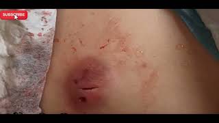 Drainage of an Infected Chest Cyst: Procedure and Care😯😯#ChestCyst #MedicalCare