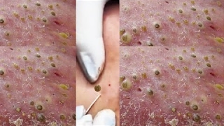 Spurt How To Remove Blackheads Easy | Blackheads On The Face Easy