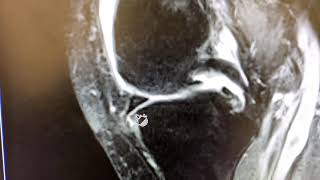 MoraMD: A Sneaky Medial Meniscus Root Tear Variant