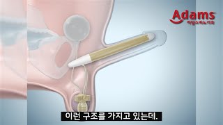 [아담스비뇨기과] 과연 파트너가 발기부전 수술 사실을 알아차릴까?