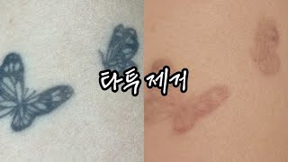 [나는 햄미] 타투 제거 직후는 어떨까?