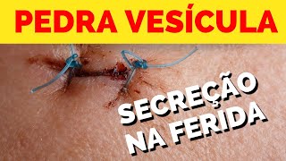 PEDRA NA VESÍCULA - Saída de secreção da ferida cirúrgica