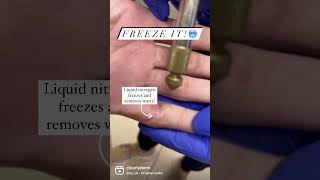 Got a wart!? Let’s freeze it🥶! #wartremoval #dermatology #bocaraton #skincare