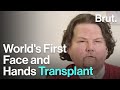 World's First Face and Hands Transplant