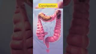 This is how constipation looks inside #viral #shorts