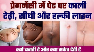 प्रेगनेंसी में नाभि की लाइन का मतलब क्या है |  Linea Nigra During Pregnancy In Hindi #lineanigra