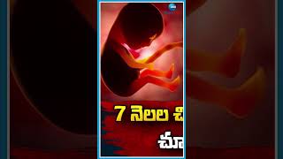 చిన్నారి కడుపులో కిలోన్నర పిండం.. | One and a Half kilograms Fetus in child's Stomach.. | ZEE Telugu