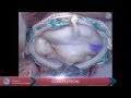 Video-atlas on minimally invasive mitral valve surgery—The David Adams technique