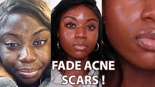 BEST INGREDIENTS TO FADE ACNE SCARS | Post Inflammatory Hyperpigmentation | PIE