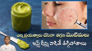 Pimple Face Pack | Reduces Acne Scars | Get Rid of Oily Skin | Smooth Skin | Manthena's Beauty Tips