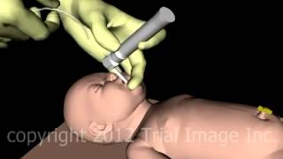 Meconium in the Newborn Airway video - Animation by Cal Shipley, M.D.